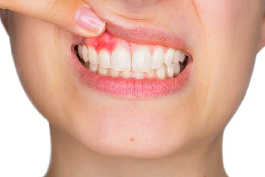 歯周病とはどんな病気か